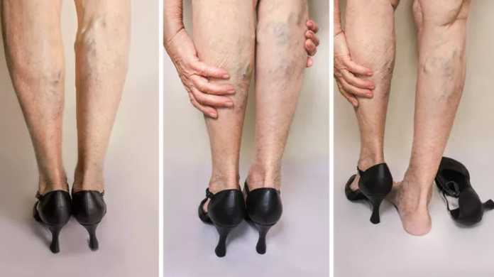 kadinlarda varisli bacak tedavisi