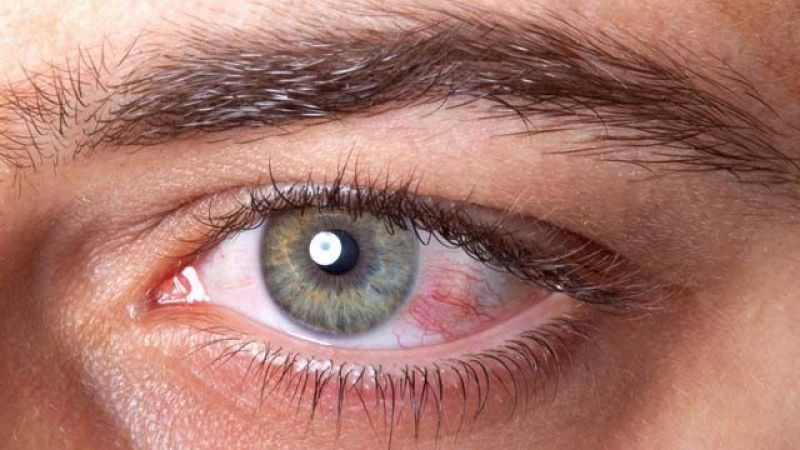 Göz Yanması Tedavisi Nasıl Yapılır?