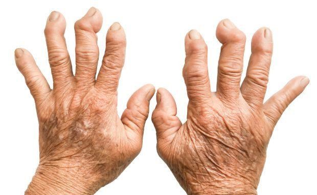Romatoid Artrit (İltihaplı Romatizma) Neden Olur? Kimlerde Görülür? Tanısı ve Tedavisi