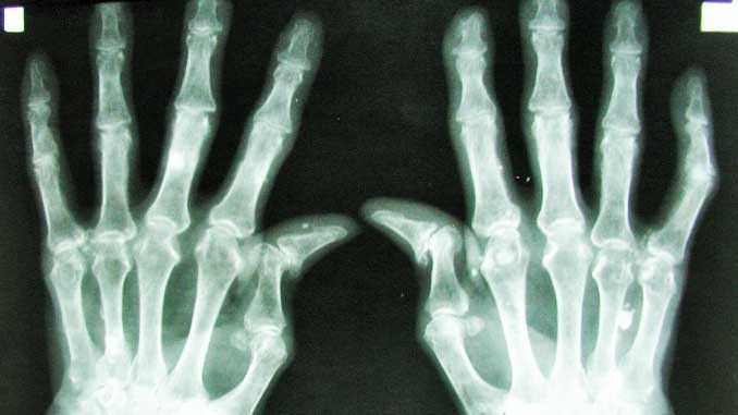 Romatoid Artrit Neden Olur? Kimlerde Görülür?