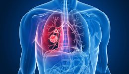 Akciğer Kanseri Neden Olur, Belirtileri Nelerdir, Kimlerde Görülür?
