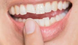 Çatlak Diş Sendromu Nedir?