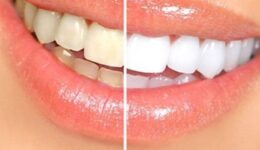 Dişler Beyazlaması için Sirke Tarifi, Fırçalama Şekli