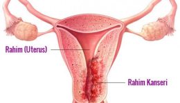 Endometrium Rahim Kanseri Neden Olur, Tanısı Nasıl Konur, Tedavisi