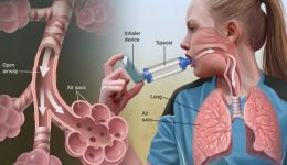 Kronik Hava Yolu Hastalıkları ve Tedavisi